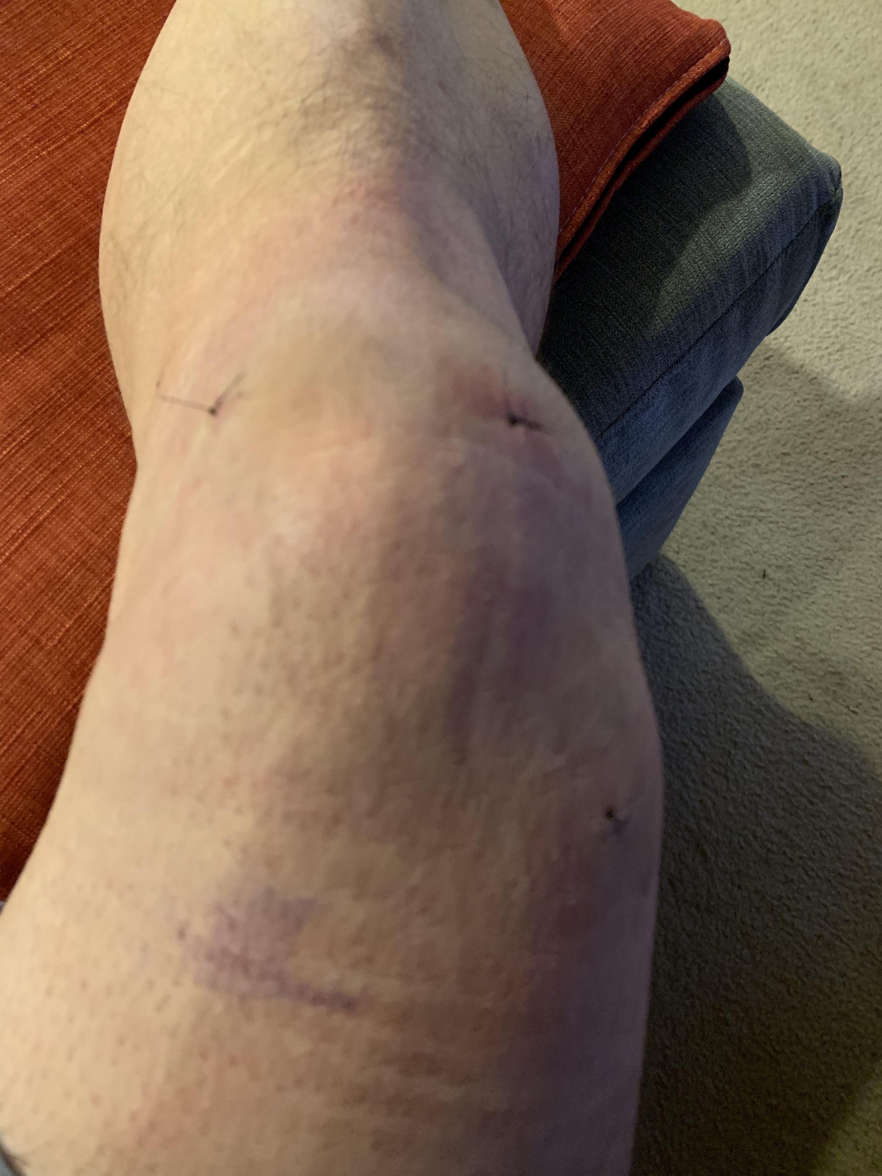 Stitches Out