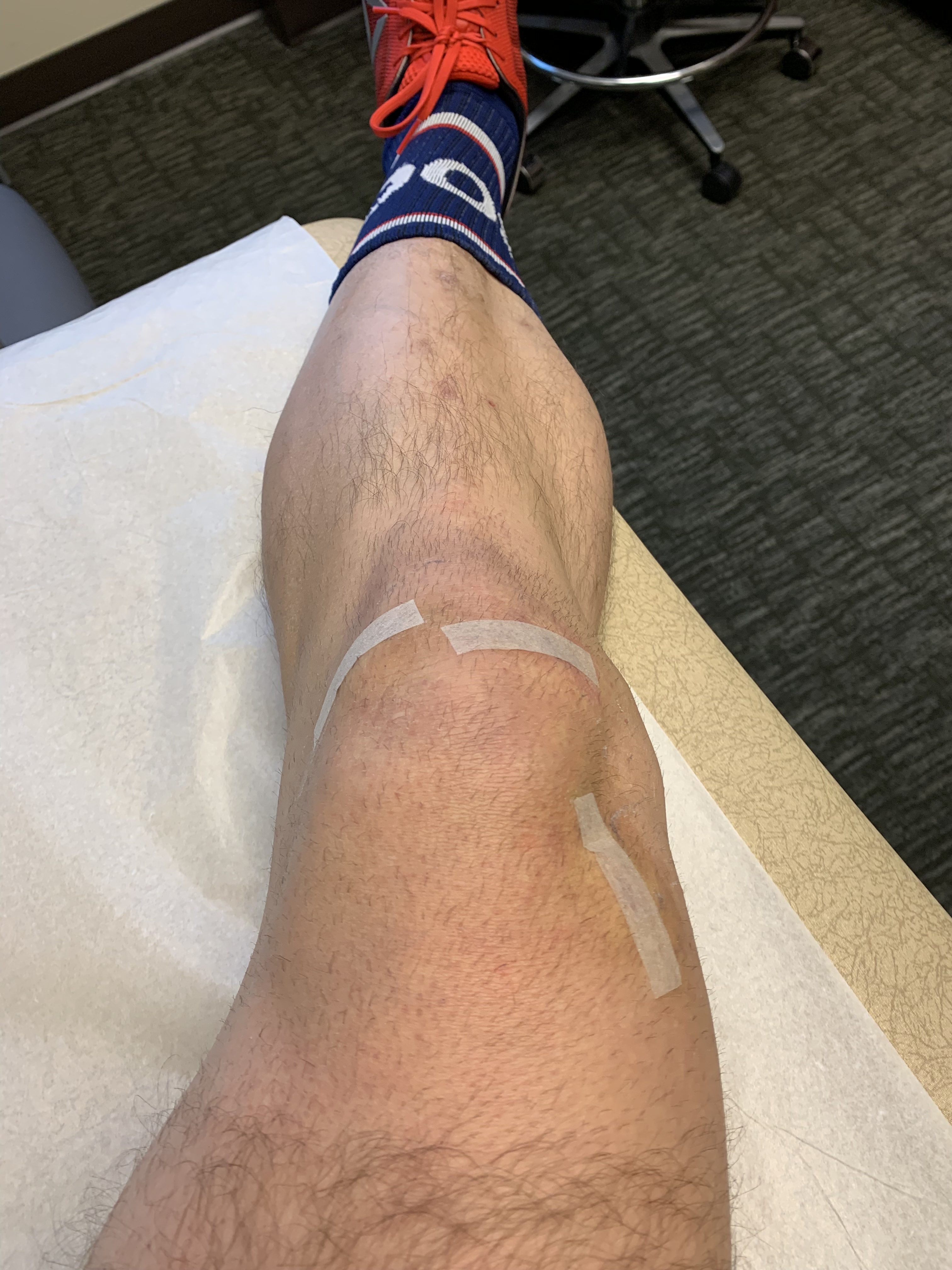 Bandages off